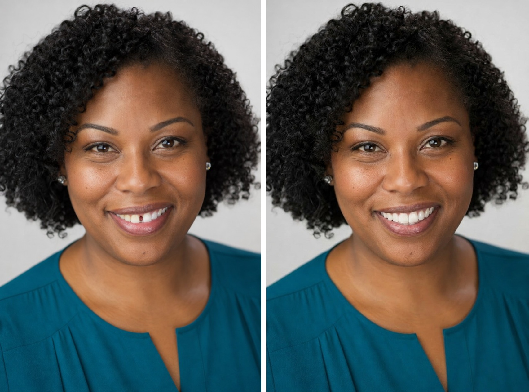 Your smile before veneers