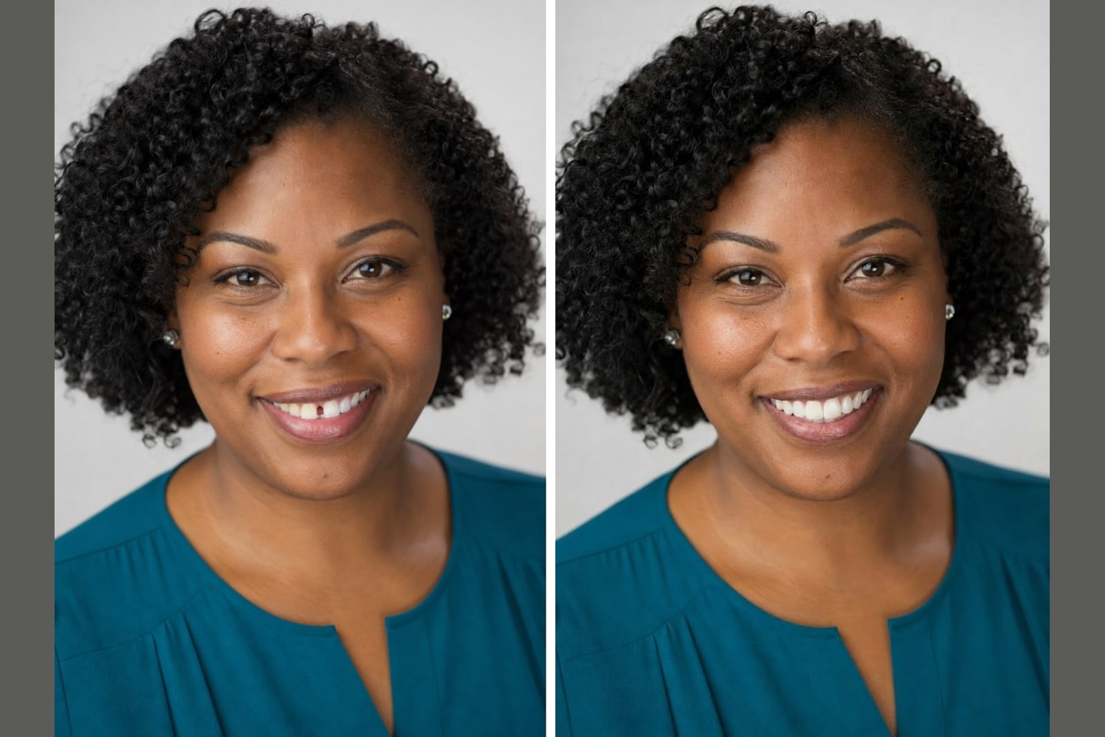 A real smile shown before and after veneers for no prep veneers