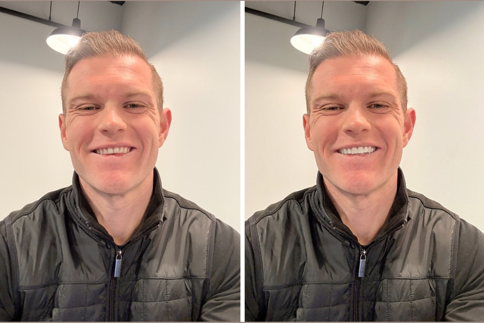A real smile shown before and after veneers, illustrating veneers for stained teeth